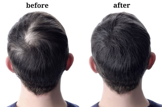espirulina para alopecia